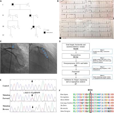 A Novel Heterozygous Variant in F2 Gene in a Chinese Patient With Coronary Thrombosis and Acute Myocardial Infarction Leads to Antithrombin Resistance